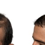 Hair Transplants Before & After Patient #786