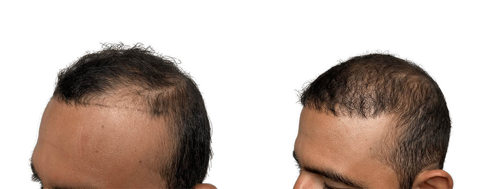 Hair Transplants Before & After Patient #786