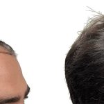 Hair Transplants Before & After Patient #790