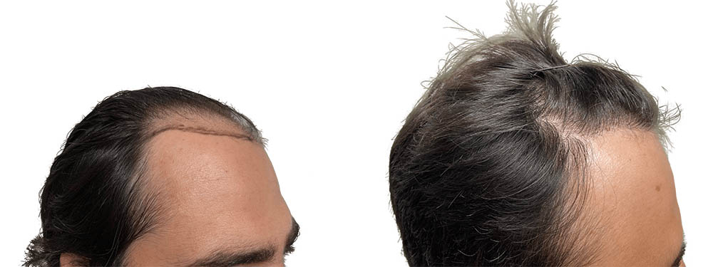 Hair Transplants Before & After Patient #790