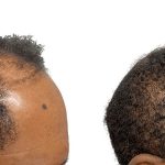 Hair Transplants Before & After Patient #661