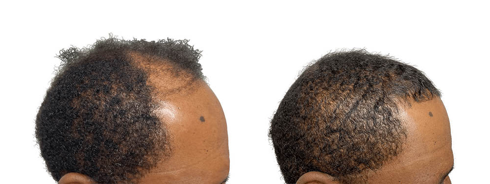 Hair Transplants Before & After Patient #661