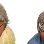 Hair Transplants Before & After Patient #667