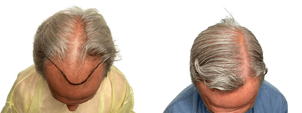 Hair Transplants Before & After Patient #667