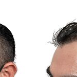 Hair Transplants Before & After Patient #687