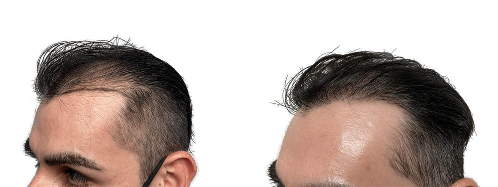 Hair Transplants Before & After Patient #687