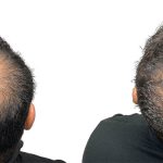 Hair Transplants Before & After Patient #688