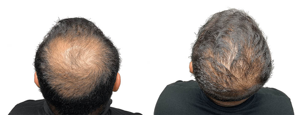 Hair Transplants Before & After Patient #688