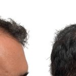 Hair Transplants Before & After Patient #694