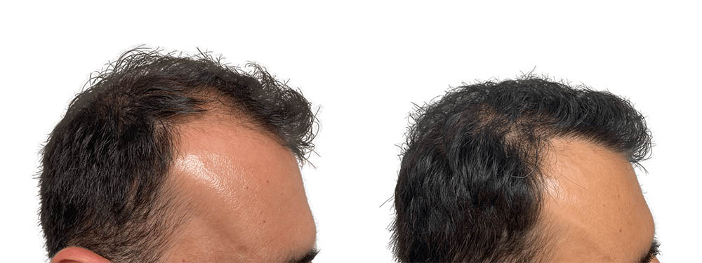 Hair Transplants Before & After Patient #694