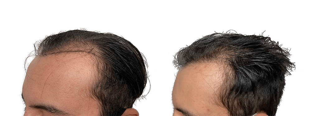 Hair Transplants Before & After Patient #714