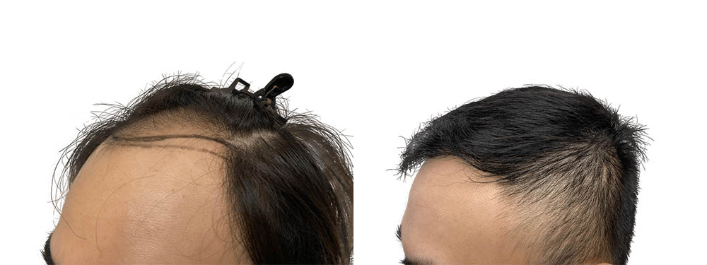 Hair Transplants Before & After Patient #728