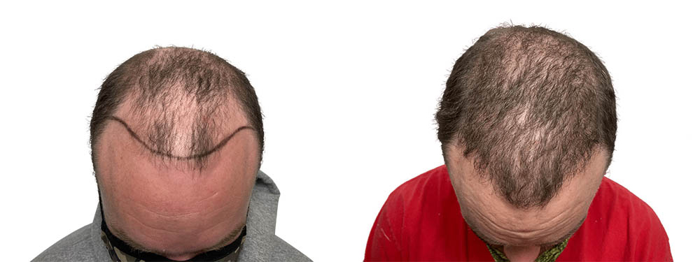 Hair Transplants Before & After Patient #733