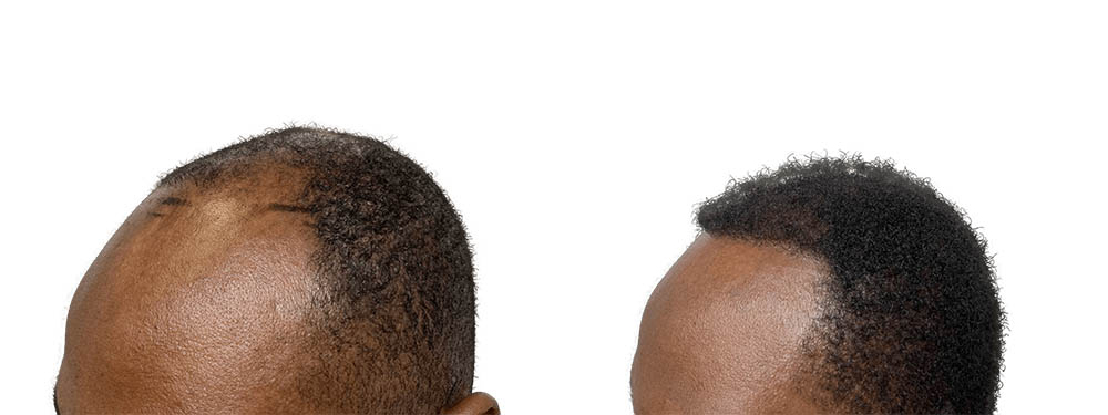 Hair Transplants Before & After Patient #743