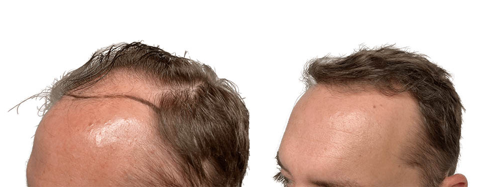 Hair Transplants Before & After Patient #748