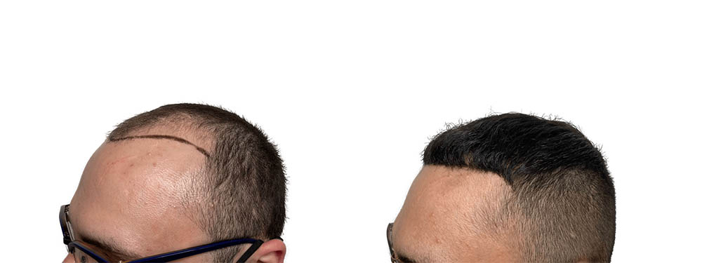 Hair Transplants Before & After Patient #757