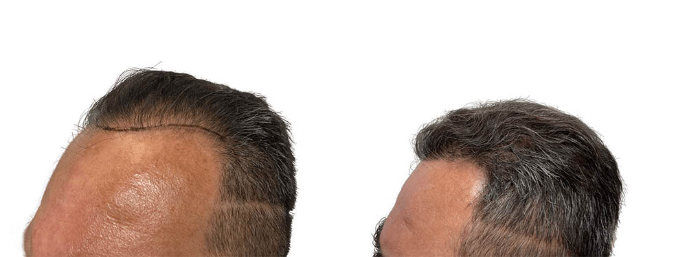 Hair Transplants Before & After Patient #762