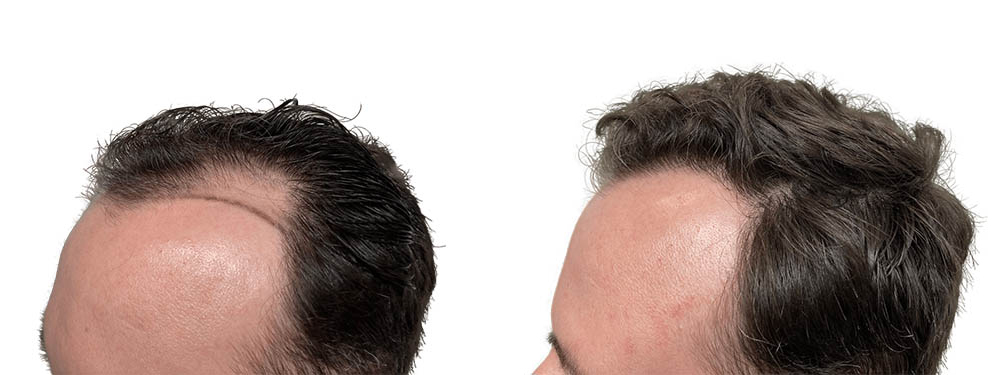 Hair Transplants Before & After Patient #773
