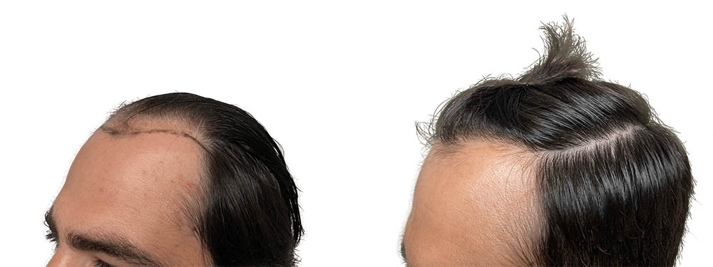 Hair Transplants Before & After Patient #790