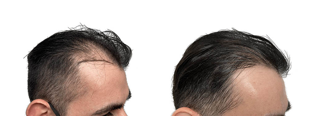 Hair Transplants Before & After Patient #687