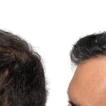 Hair Transplants Before & After Patient #694