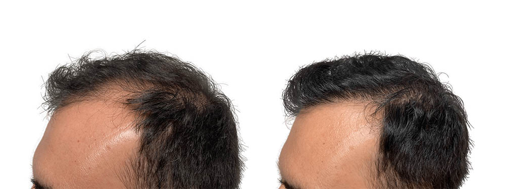 Hair Transplants Before & After Patient #694