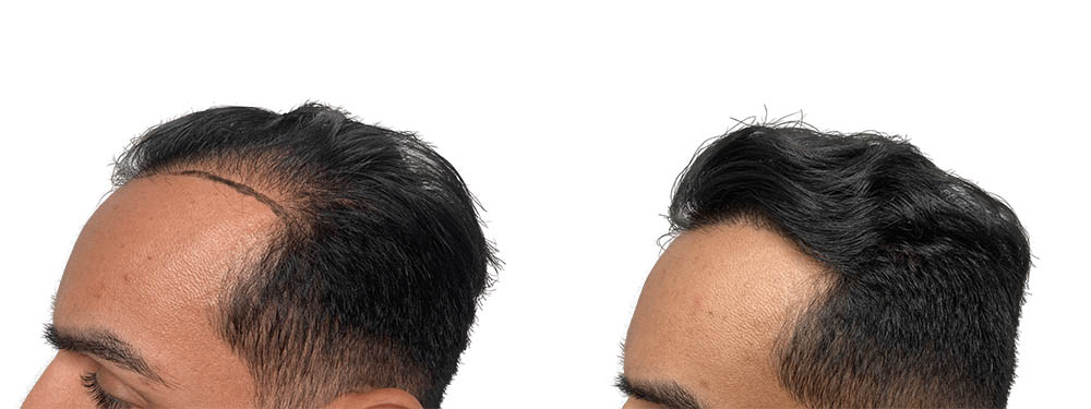 Hair Transplants Before & After Patient #704