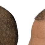 Hair Transplants Before & After Patient #699