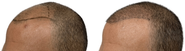 Hair Transplants Before & After Patient #699