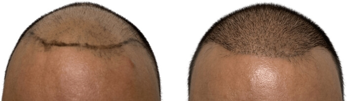 Hair Transplants Before & After Patient #699