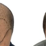 Hair Transplants Before & After Patient #699