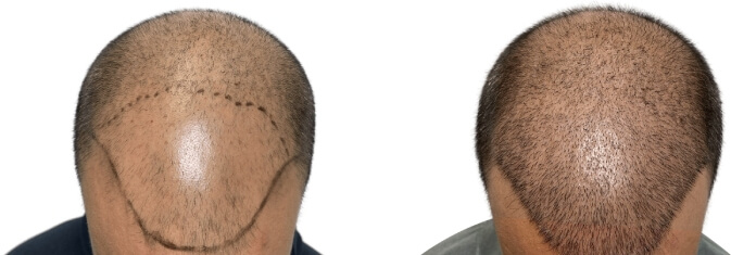 Hair Transplants Before & After Patient #699