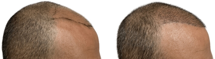 Hair Transplants Before & After Patient #699