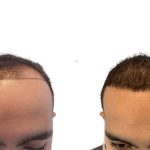 Hair Transplants Before & After Patient #588
