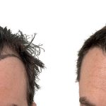 Hair Transplants Before & After Patient #610