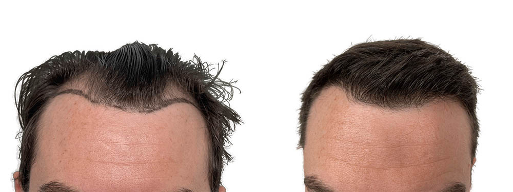 Hair Transplants Before & After Patient #610
