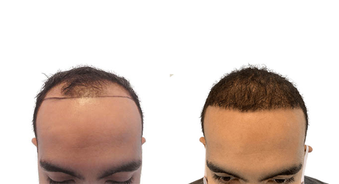 Hair Transplants Before & After Patient #588