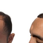 Hair Transplants Before & After Patient #588