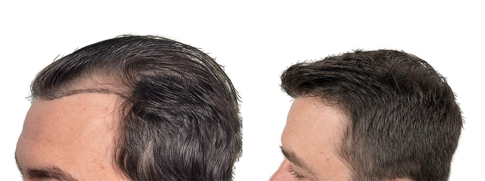 Hair Transplants Before & After Patient #610