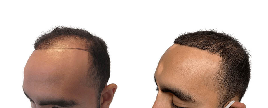 Hair Transplants Before & After Patient #588