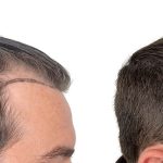 Hair Transplants Before & After Patient #610