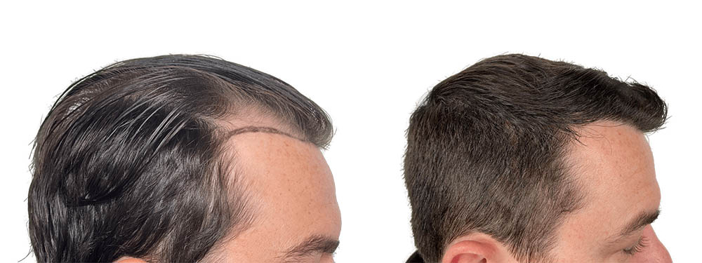 Hair Transplants Before & After Patient #610