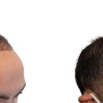 Hair Transplants Before & After Patient #588