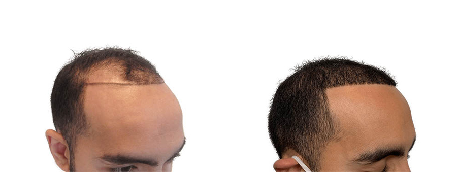 Hair Transplants Before & After Patient #588