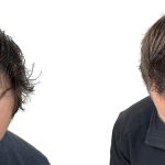 Hair Transplants Before & After Patient #610