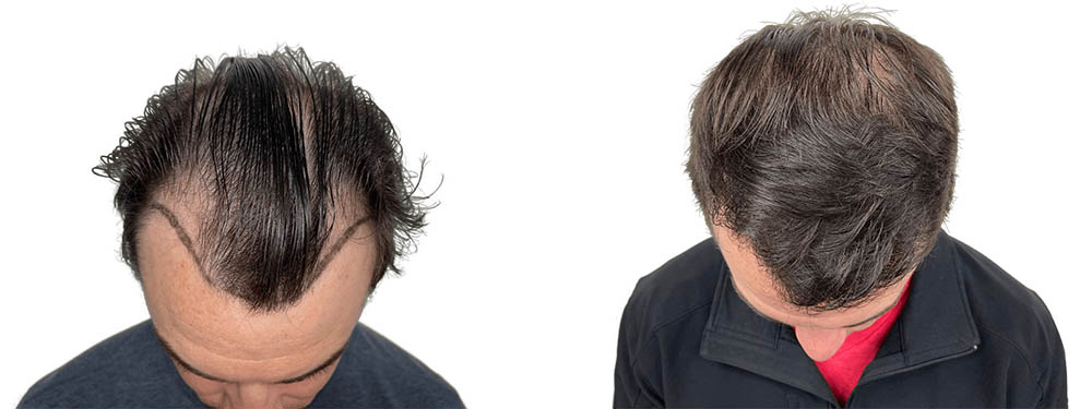 Hair Transplants Before & After Patient #610