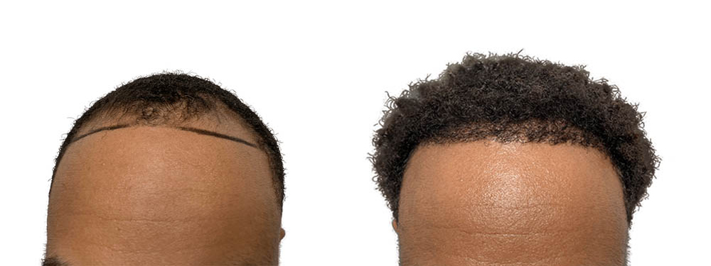 Hair Transplants Before & After Patient #592