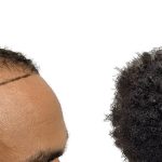 Hair Transplants Before & After Patient #592