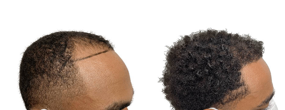 Hair Transplants Before & After Patient #592