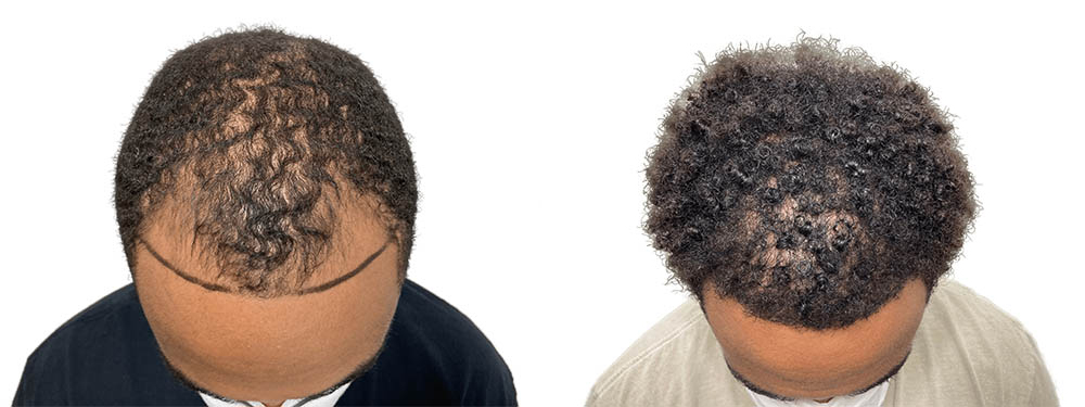 Hair Transplants Before & After Patient #592